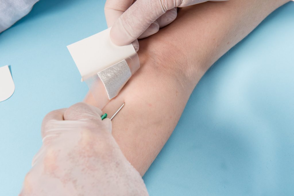 Medicazione all’argento in fistole Buttonhole Emodial